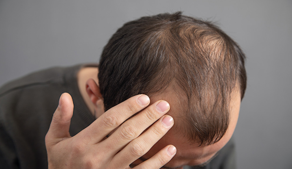 Hair Loss Treatment